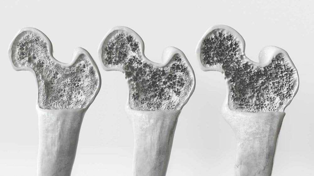 X-ray illustration showing bone density loss associated with osteoporosis after age 50